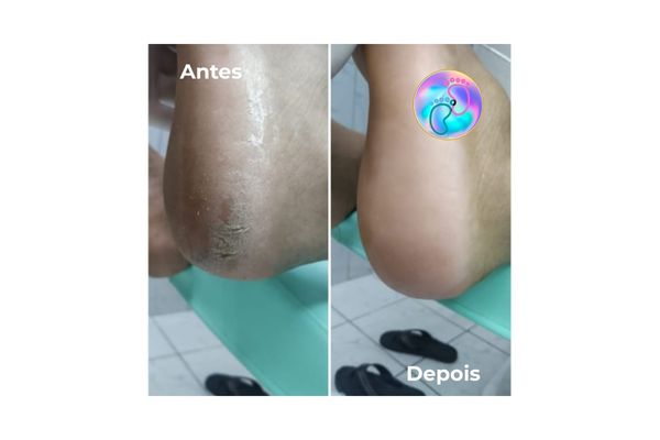 Foto de antes e depois do tratamento 43